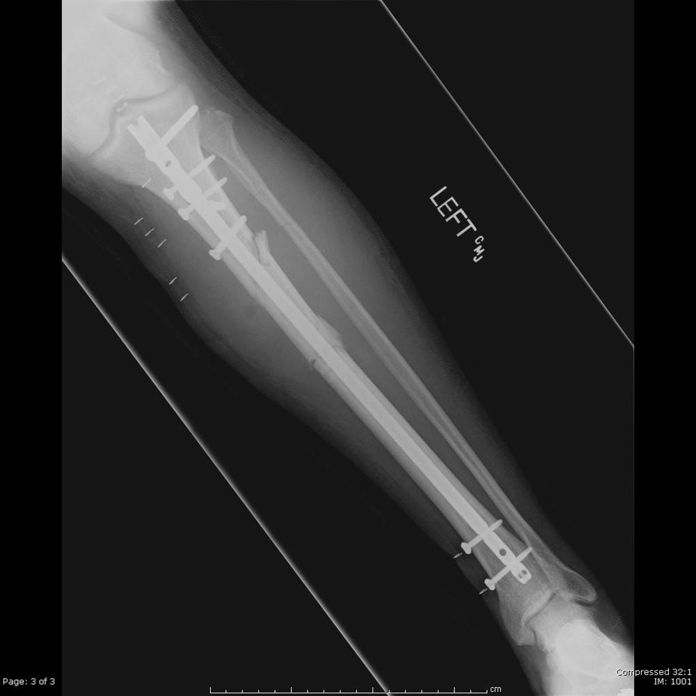 Tibia Shaft Fractures Trauma Orthobullets
